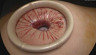 Laparoscopic Management of Giant <mark class="highlighted">Ovarian Cysts</mark> Using the Alexis Laparoscopic System®: A Case Series